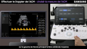 tutoriel echographie doppler de l acm samsung v7