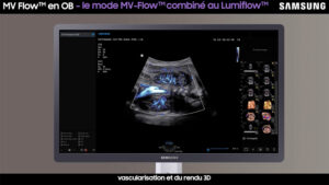 tutoriel echographie mv flow obstetrique samsung v7