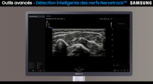 tutoriel echographie alr nerve track samsung V7