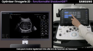 tutoriel echographie obstetrique samsung V7 mode 2D