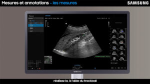 tutoriel echographie samsung V7 mesures et annotations