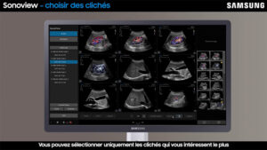 tutoriel echographie samsung V7 sonoview