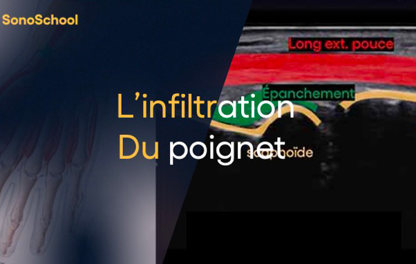 infiltration_poignet_echographie_jimmy_gross_sonoschool