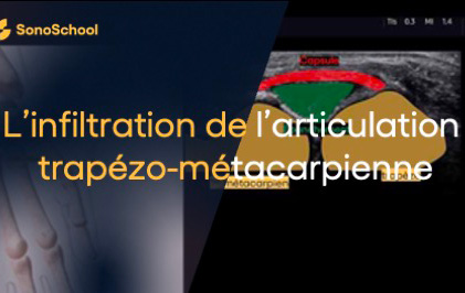 infiltration_trapezo_metacarpienne_echographie_jimmy_gross_sonoschool