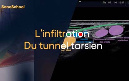 infiltration_tunnel_tarsien_echographie_sonoschool