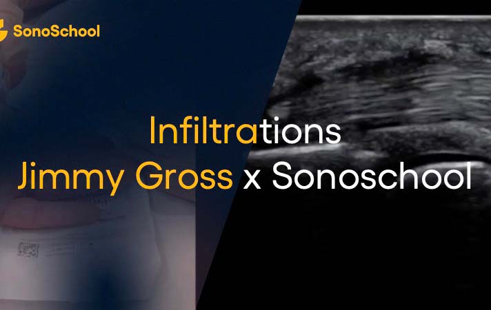 infiltrations_echoguidees_sonoschool