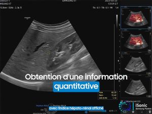 steatose_hepatique_ez_hri_echographie_samsung