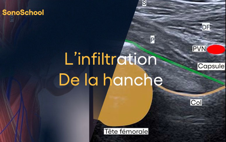 infiltration_hanche_sous_echographie_jimmy_gross_sonoschool