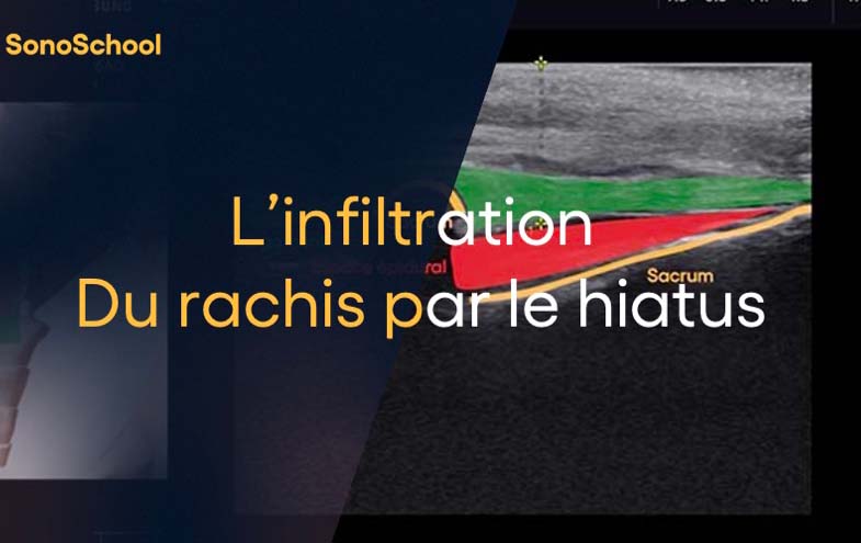 infiltration_rachis_echographie_hiatus_sonoschool_jimmy_gross