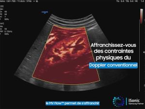 microvascularisation_mv_flow_echographie_samsung
