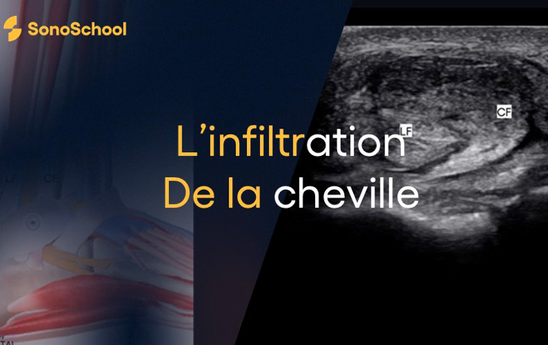 Infiltration_cheville_tendon_peronier_echographie_jimmy_gross_sonoschool