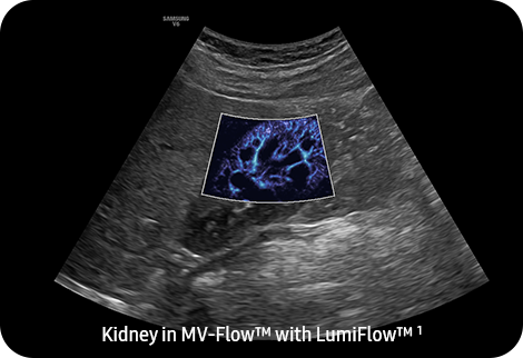 echographe_samsung_v6_lumiflow