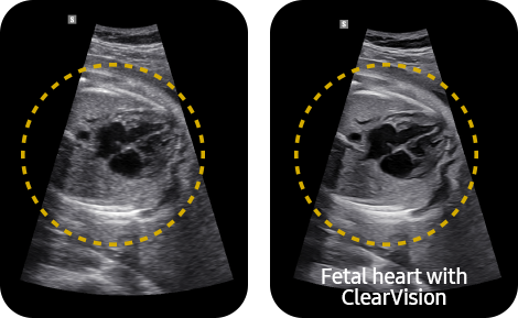 clearvision_echographe_samsung_v6_gynecologie_obstetrique