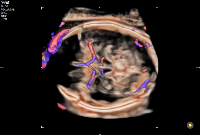 crystal_vue_echographe_samsung_v6_gynecologie_obstetrique