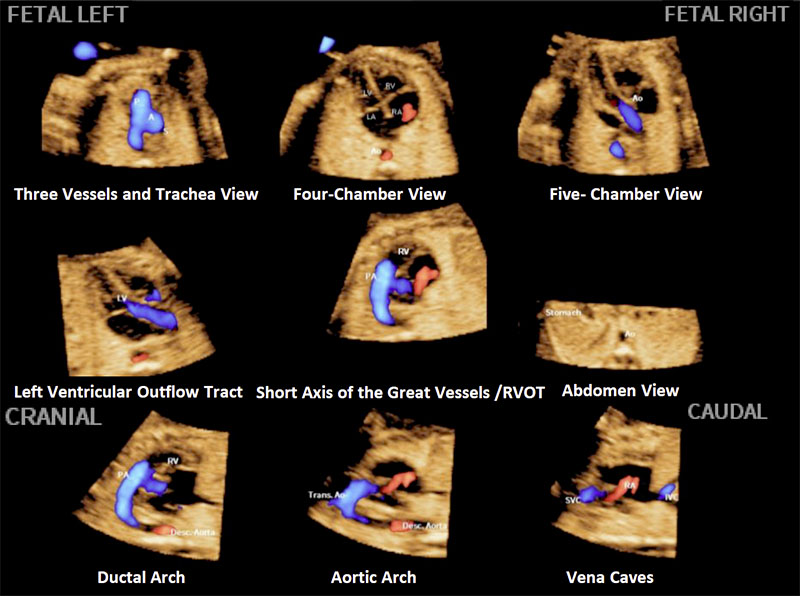 echographe_samsung_v6_gynecologie_obstetrique_5D_heart_color