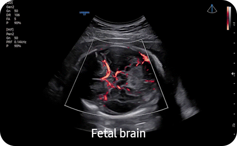 echographe_samsung_V6_gynecologie_obstetrique_mv_flow