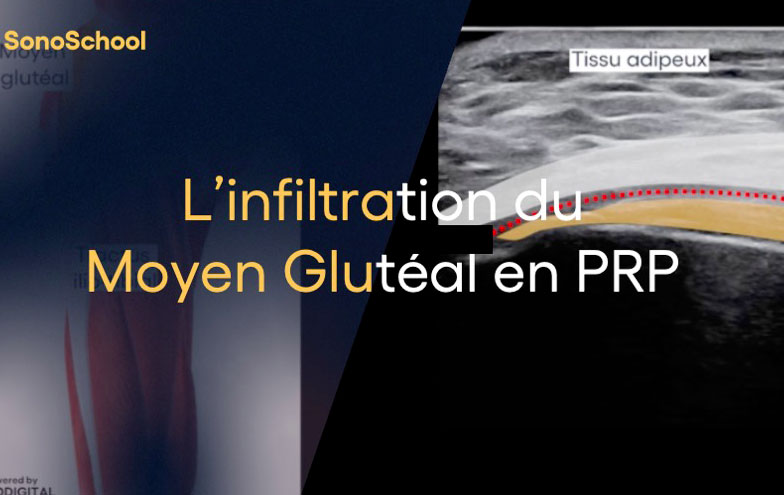 infiltration_prp_moyen_gluteal_echographie_sonoschool_jimmy_gross