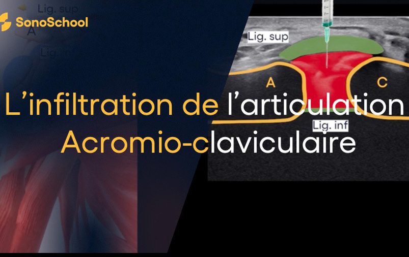 infiltration_acromio_claviculaire