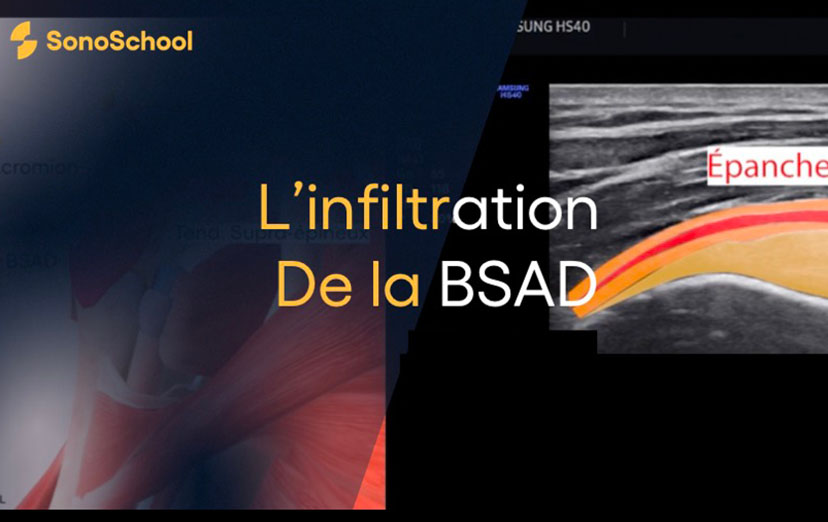 infiltration_bsad_sonoschool
