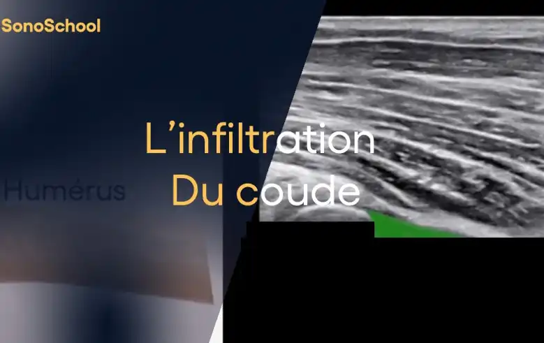 infiltration_coude_echographie_jimmy_gross_sonoschool
