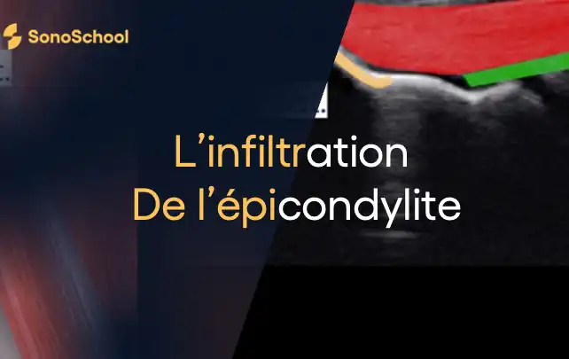 infiltration_epicondylite_echographie_sonoschool_jimmy_gross