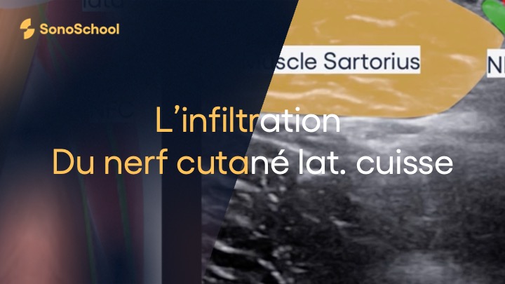 infiltration_nerf_cutané_latéral_cuisse_echographie_sonoschool_jimmy_gross