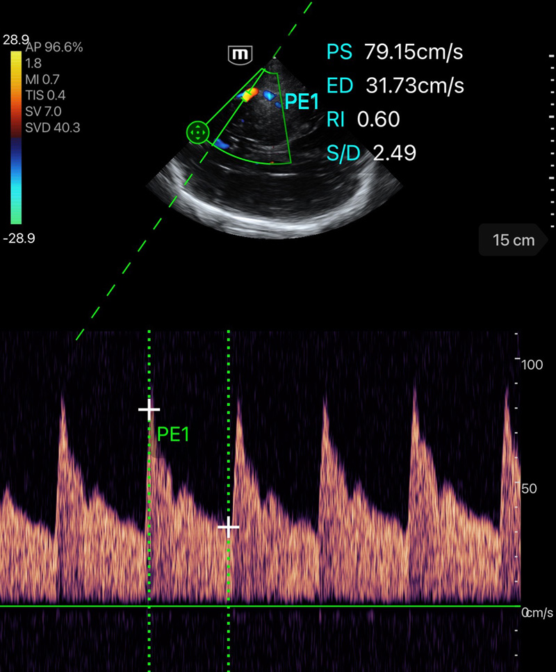 TE Air mode Doppler Pulsé