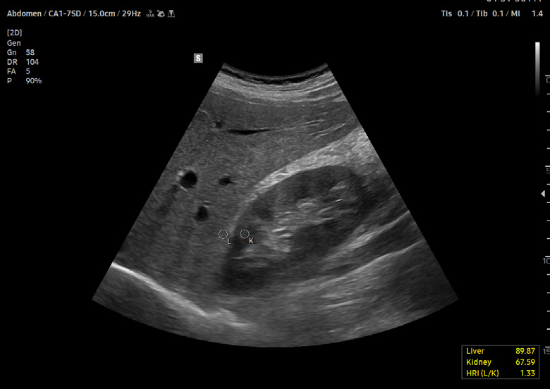 V5 HRI (Hepato Renal Index)