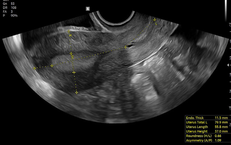 V5 UterineAssist™