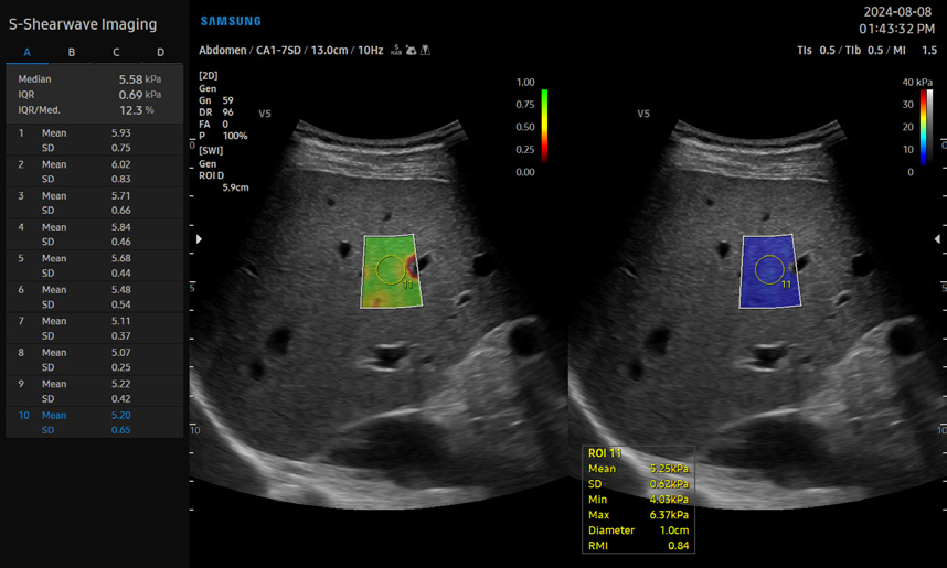 V5 S-Shearwave Imaging™