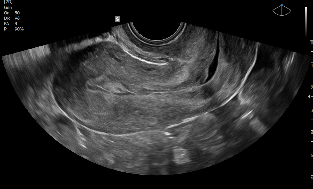 Polype uterus