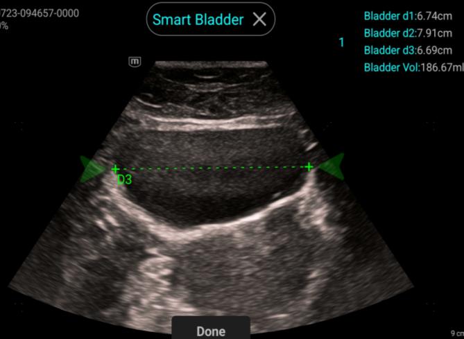 Smart Bladder