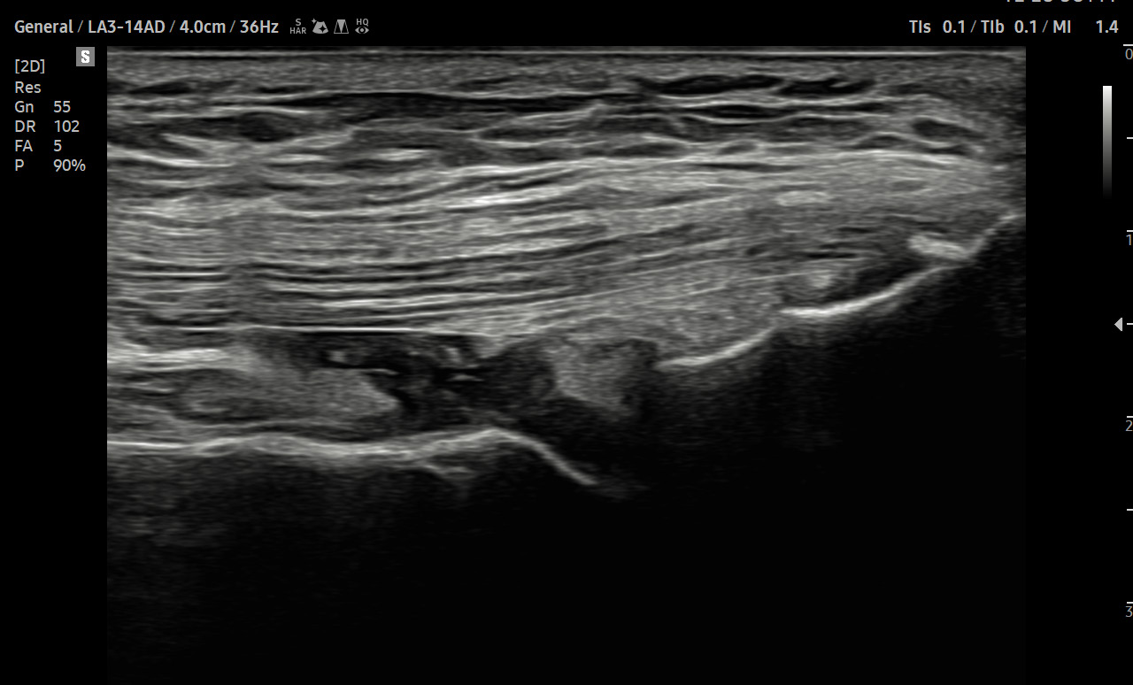 Tendon suprapatellaire avec HQ-Vision™