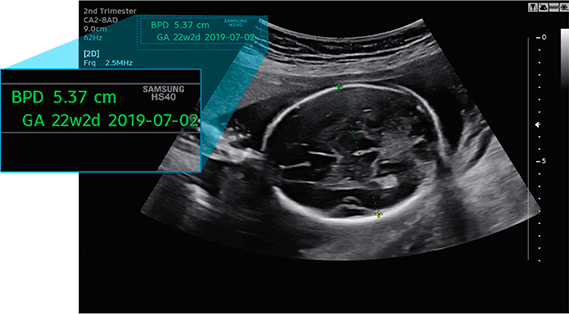 Echographe Samsung HS40 Biometry Assist Echographe Samsung HS40 Biometry Assist